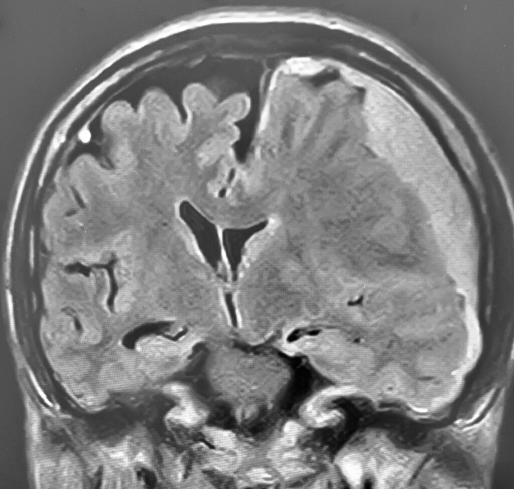 慢性硬膜下血腫